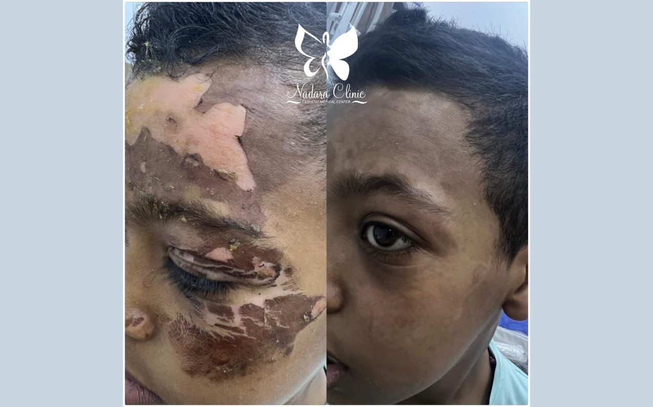 Burn treatment doctor in Hurghada